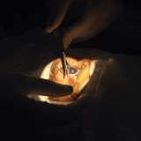 Eye surgery in Zambia.